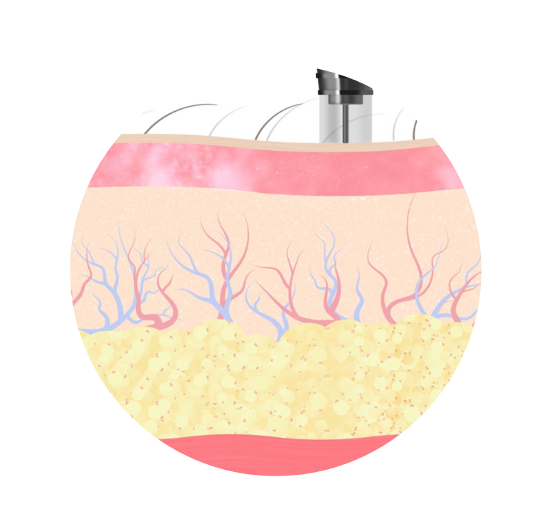 procedure1
