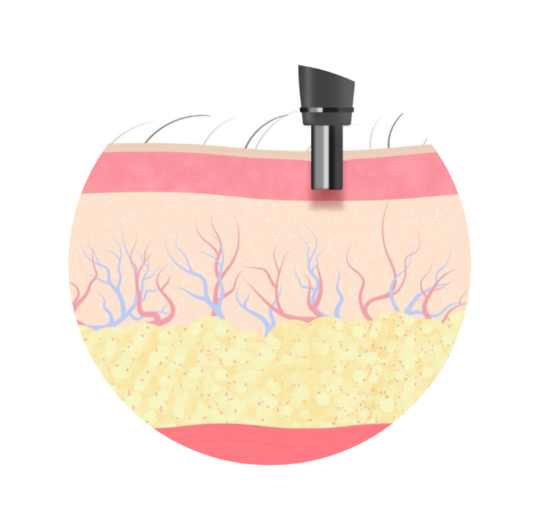 procedure2