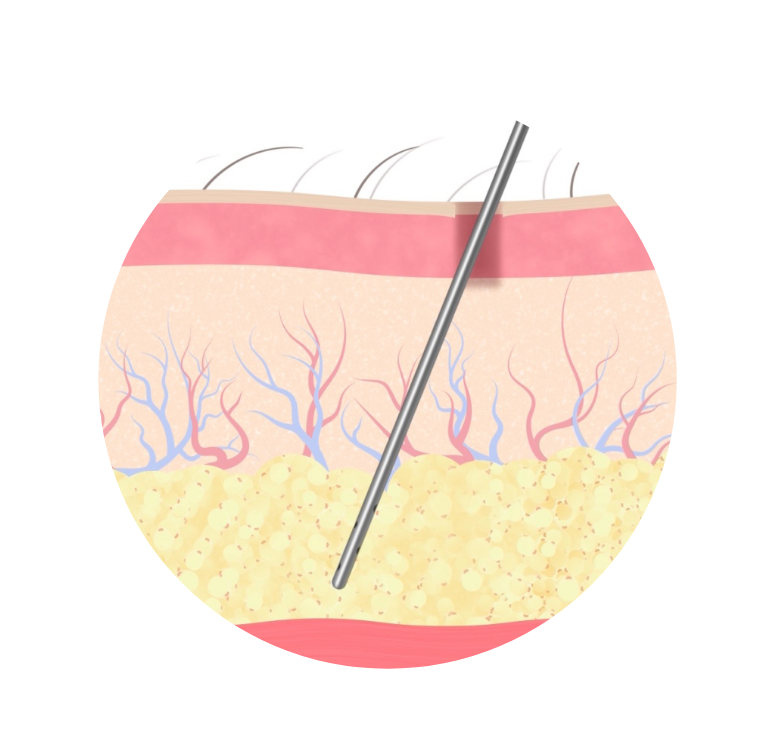 procedure3