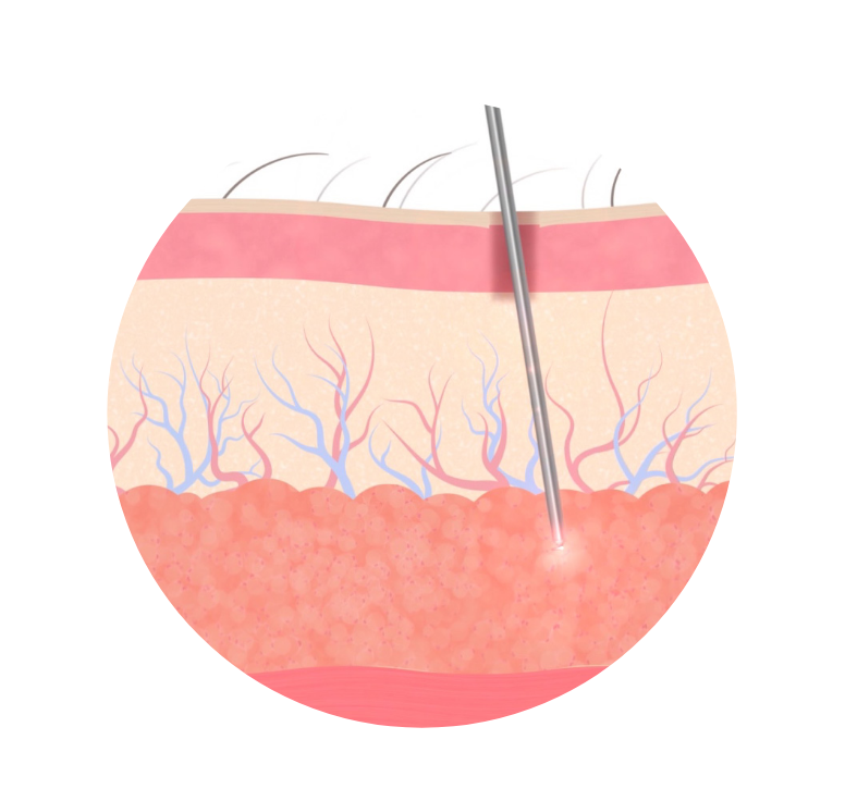 illustration of cannula entering the skin to reach fat