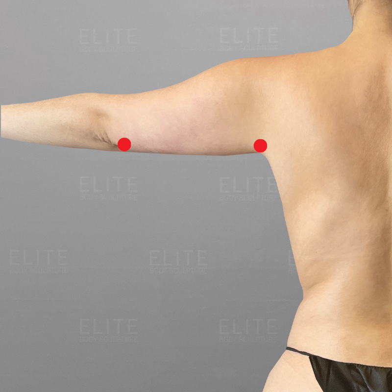 Permanent Arm Fat Removal Arm Liposuction With AirSculpt