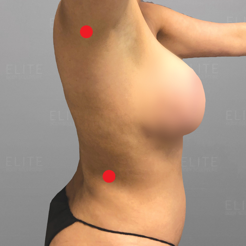 upper back airsculpt entry points