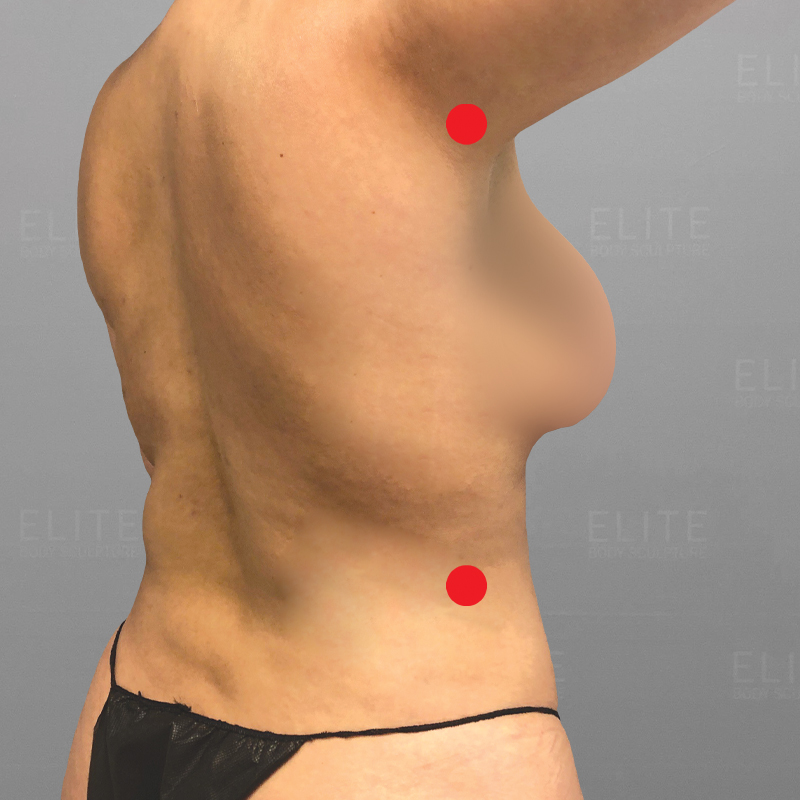 upper back airsculpt entry points