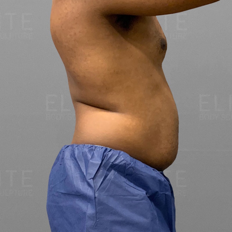 before 48 hour six pack airsculpt