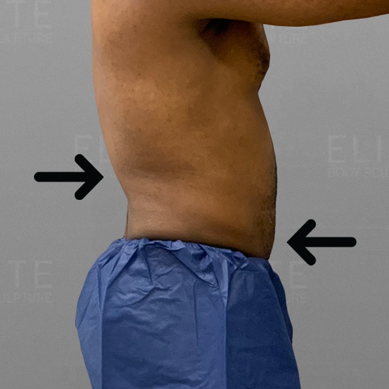 after 48 hour six pack airsculpt