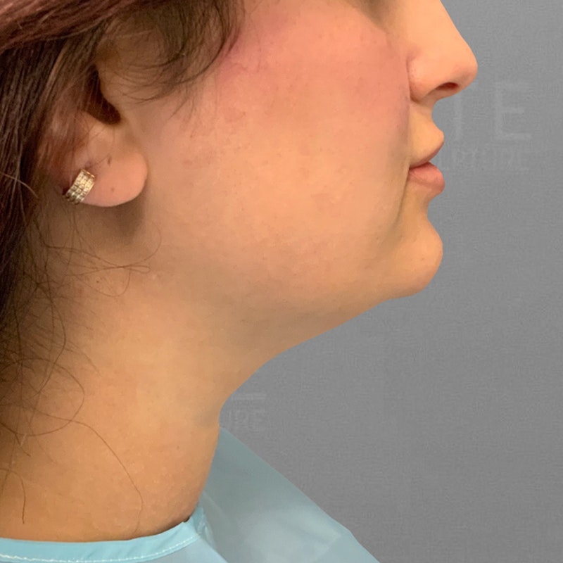 before chin airsculpt