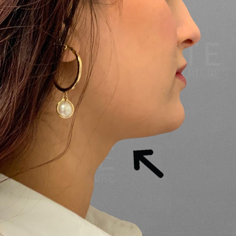 after chin airsculpt