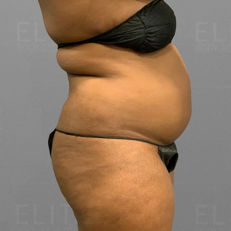 before airsculpt body contouring