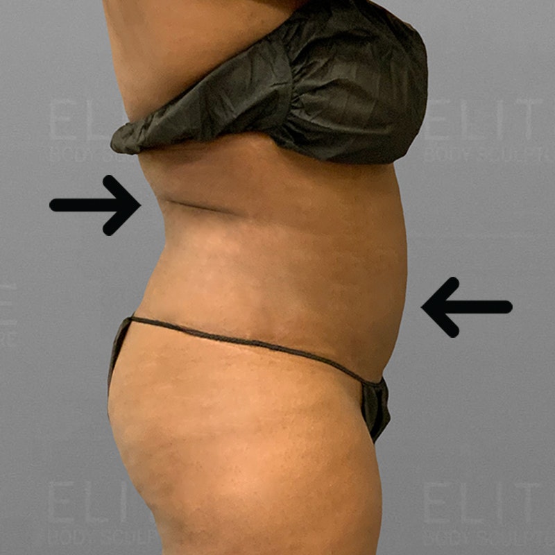 after airsculpt body contouring