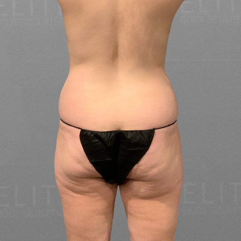 Before Back, stomach, banana roll, BBL AirSculpt