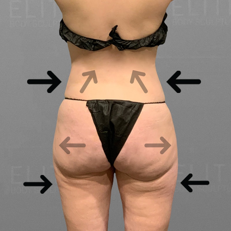 After Back, stomach, banana roll, BBL AirSculpt