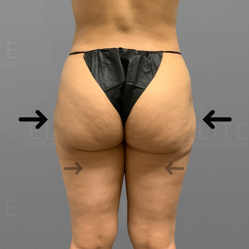 after saddlebag lipo