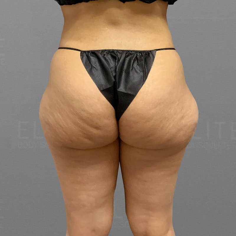 before saddlebag lipo