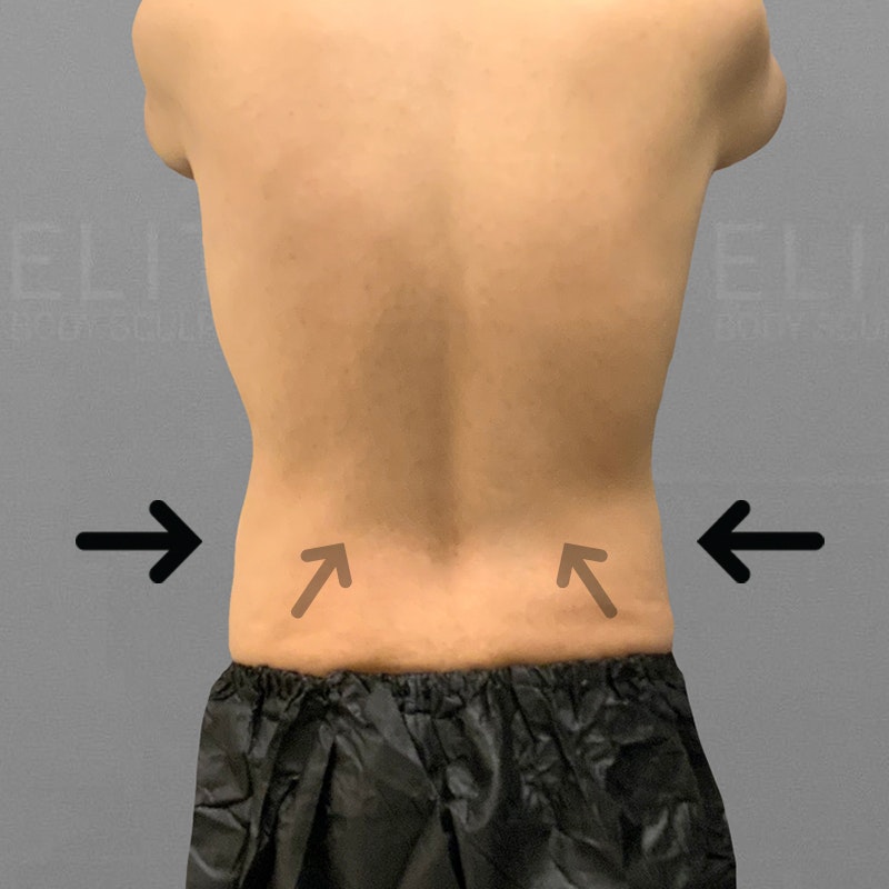 after waist airsculpt