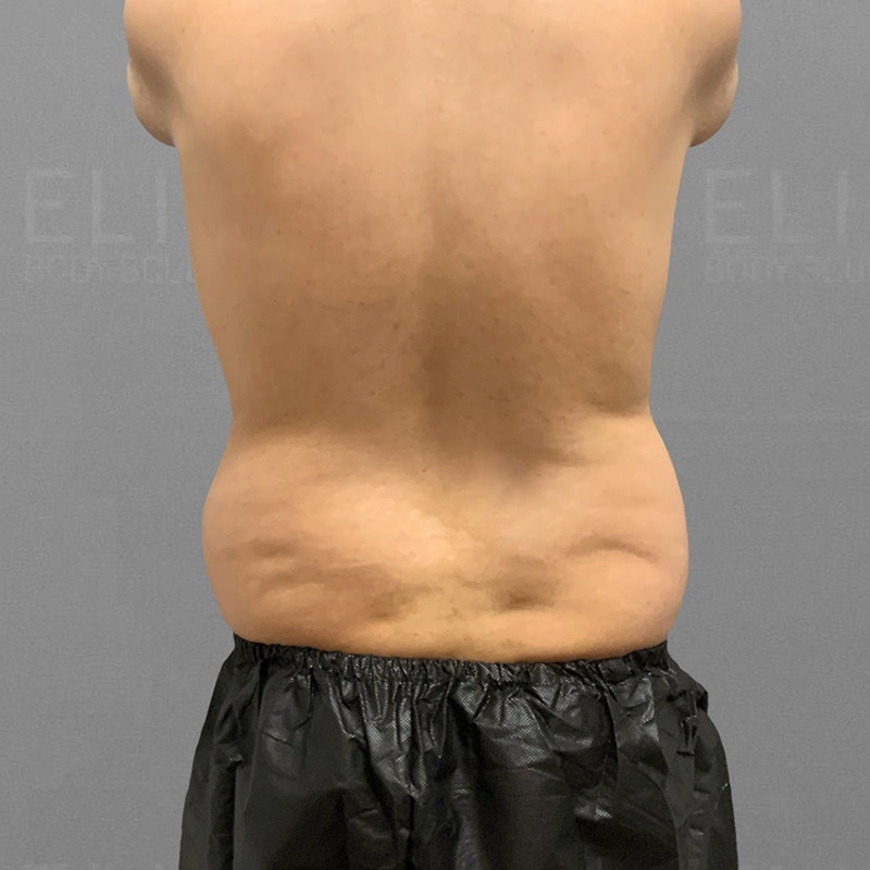 before waist airsculpt