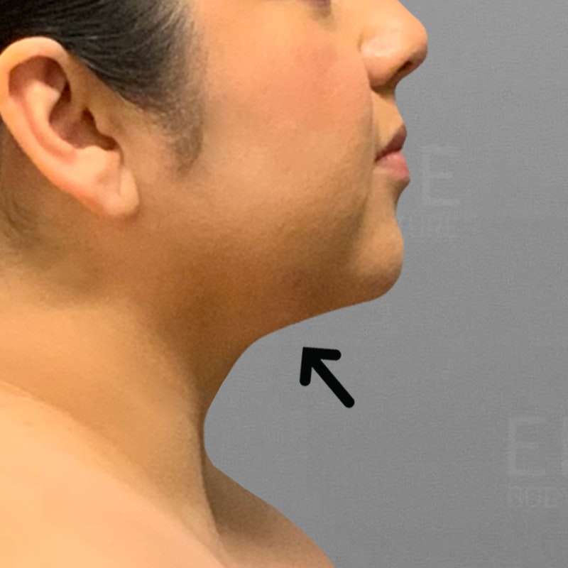 after chin airsculpt