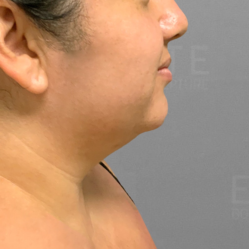 before chin airsculpt
