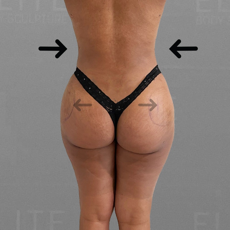 after hip flip and back airsculpt