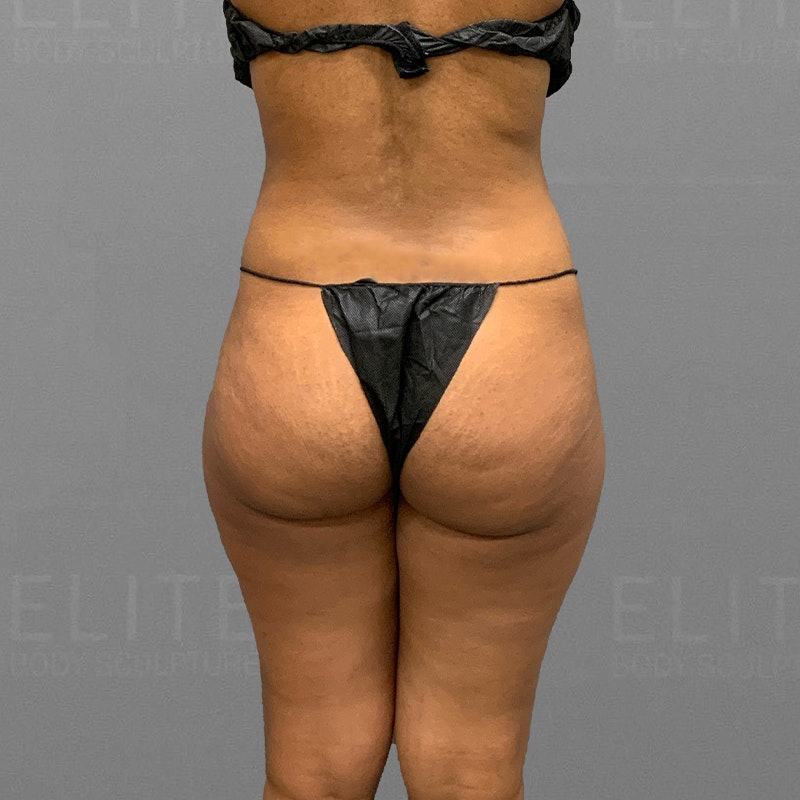 before hip flip and back airsculpt