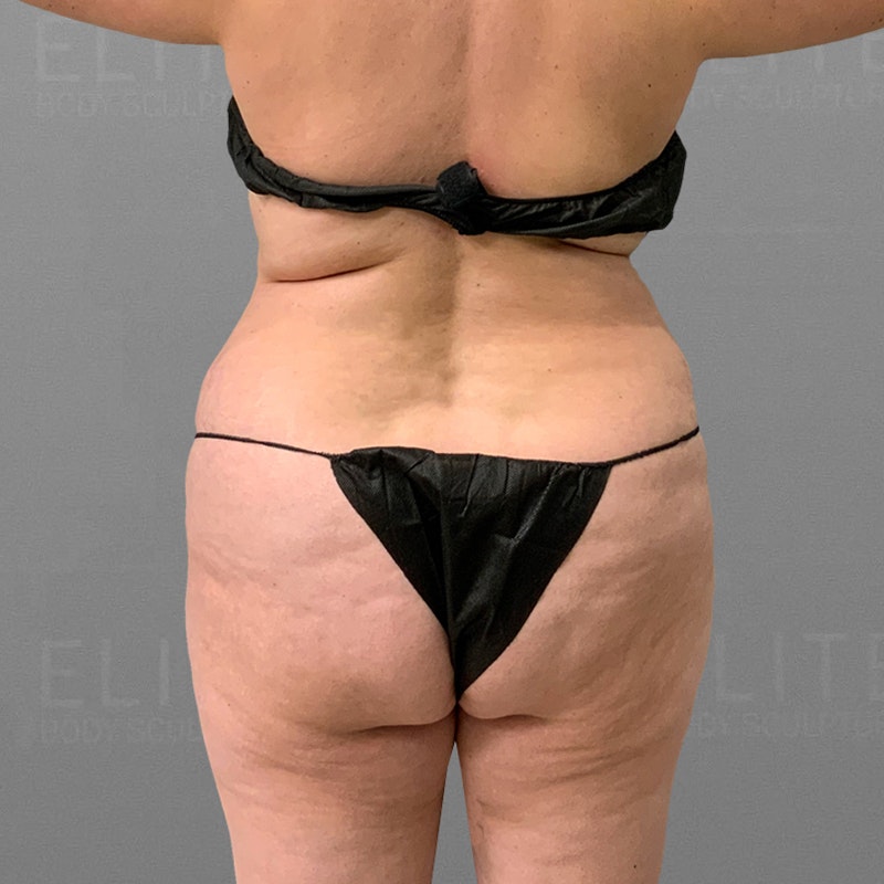 waist and back bra roll airsculpt before