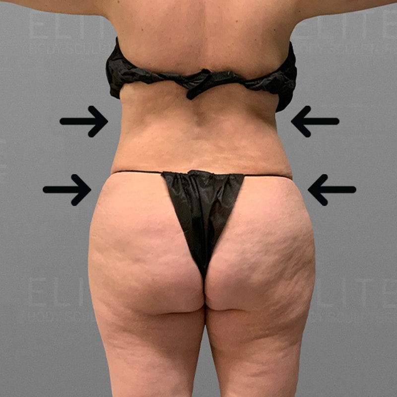 waist and back bra roll airsculpt after
