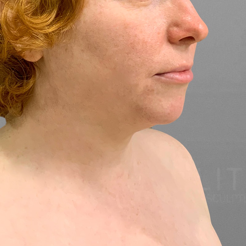 before chin airsculpt