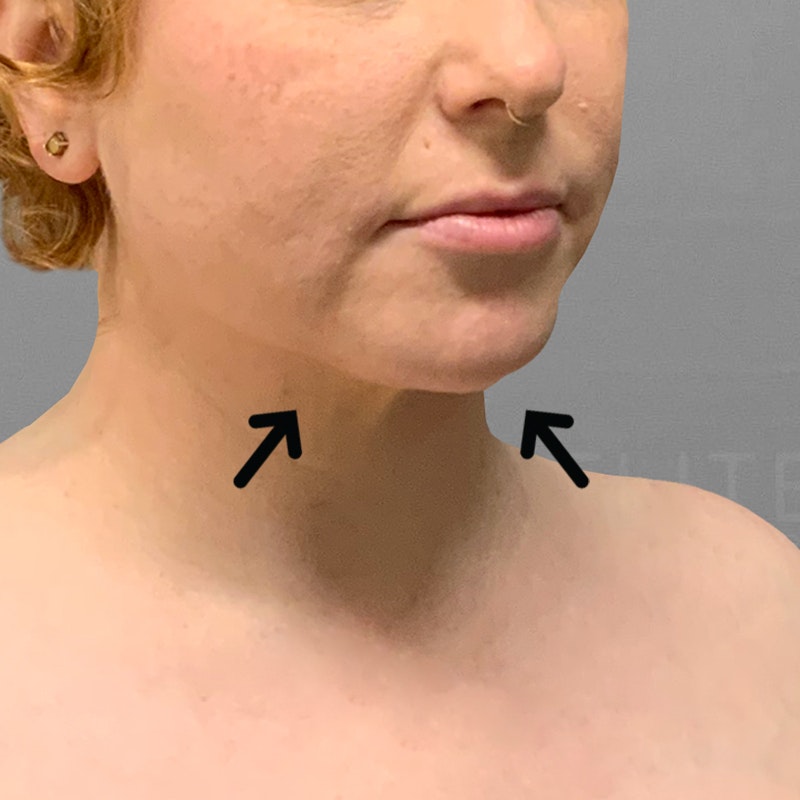 after chin airsculpt