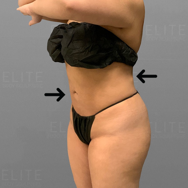 after stomach airsculpt