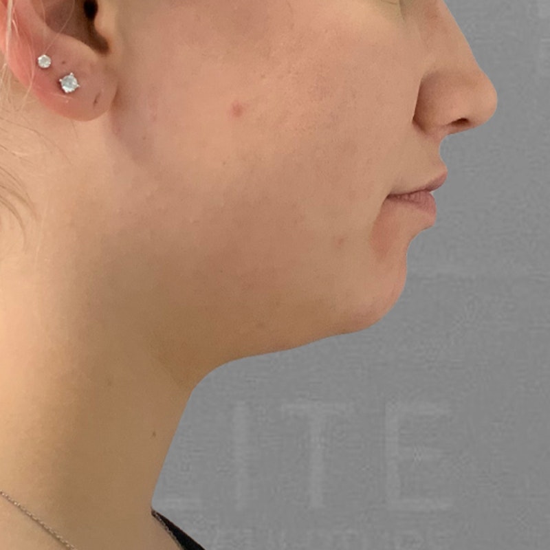 before chin airsculpt