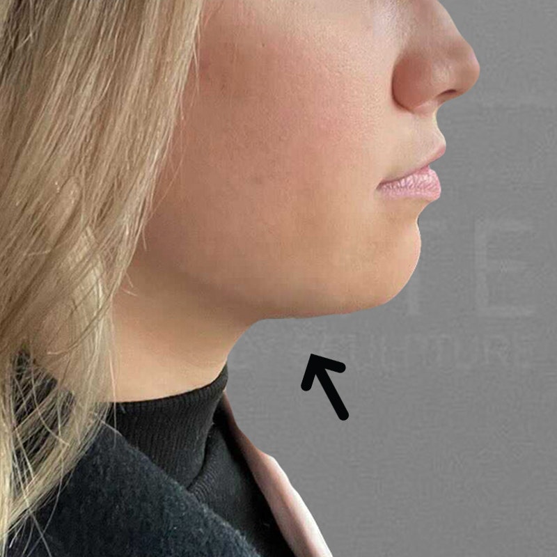 after chin airsculpt