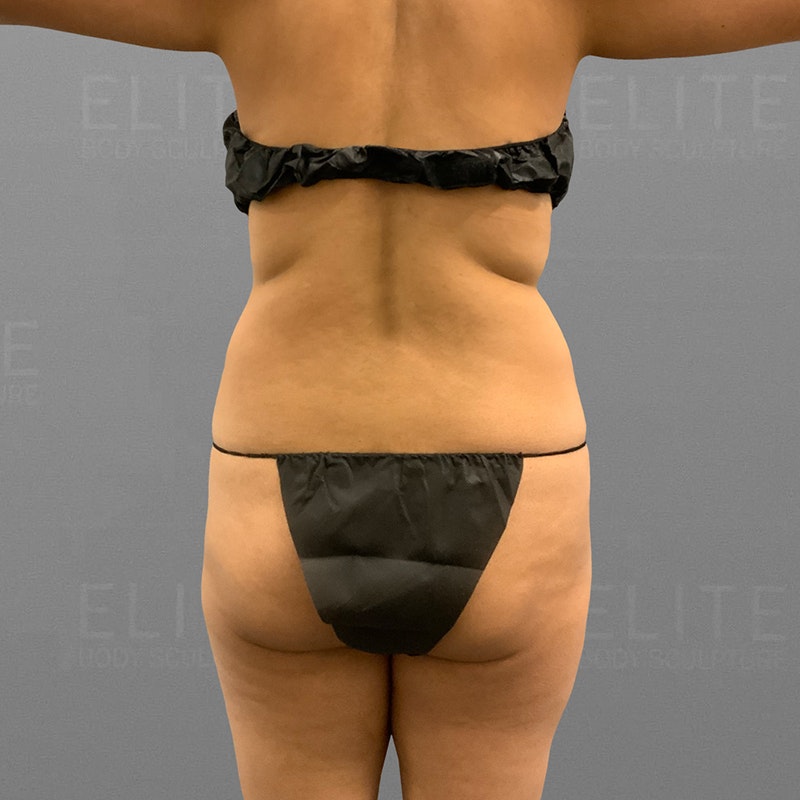 Before airsculpt bbl