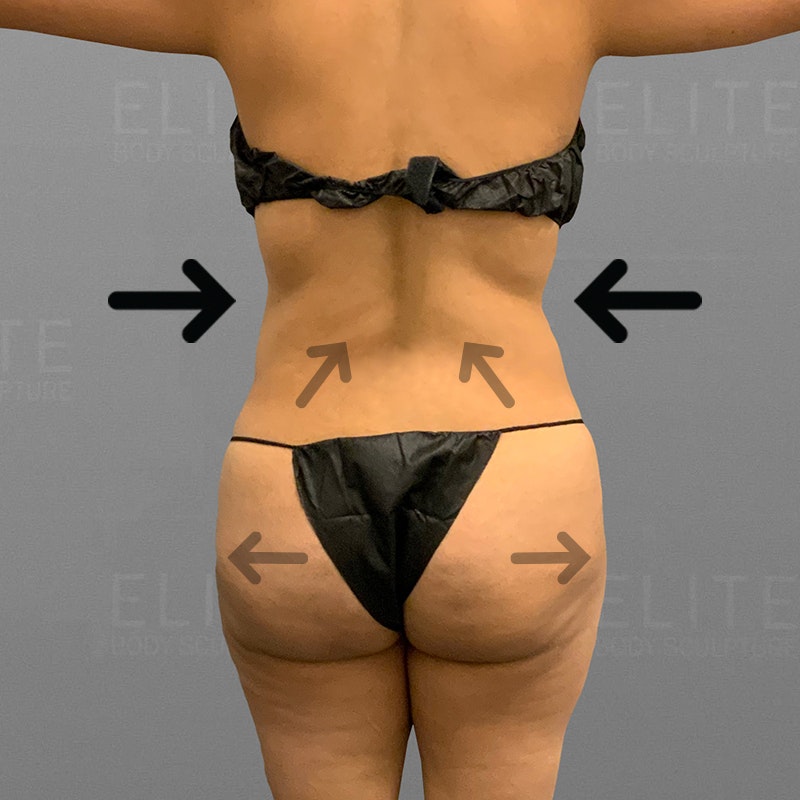 after airsculpt bbl
