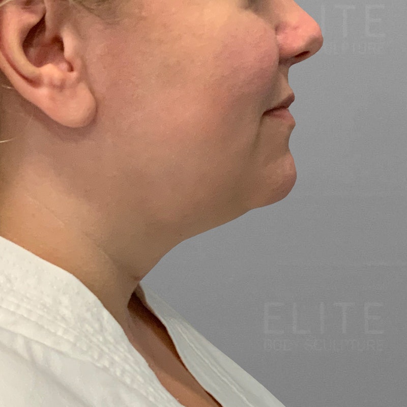 submental liposuction before
