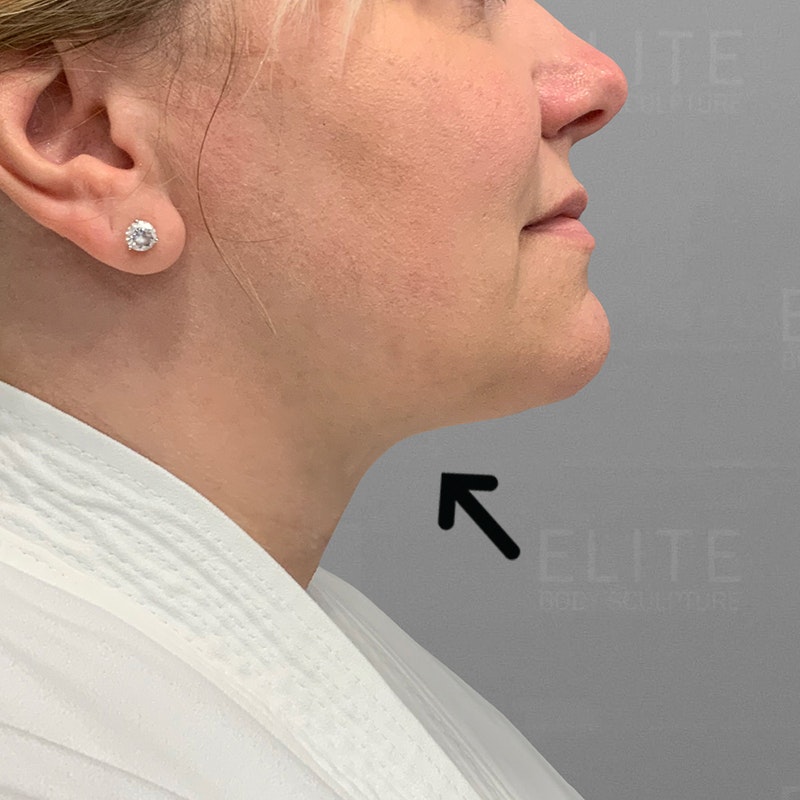 submental liposuction after