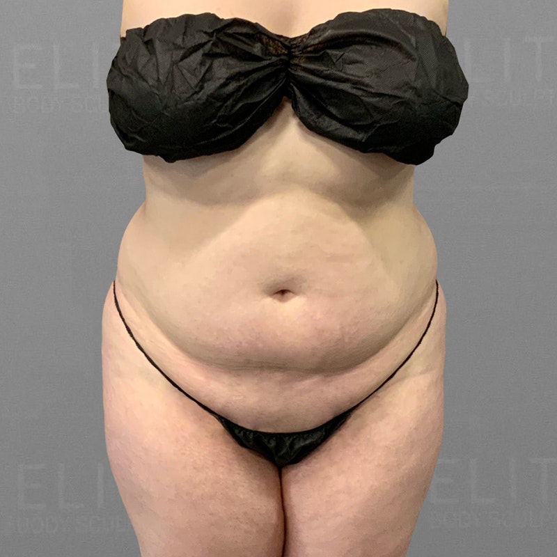 before stomach airsculpt