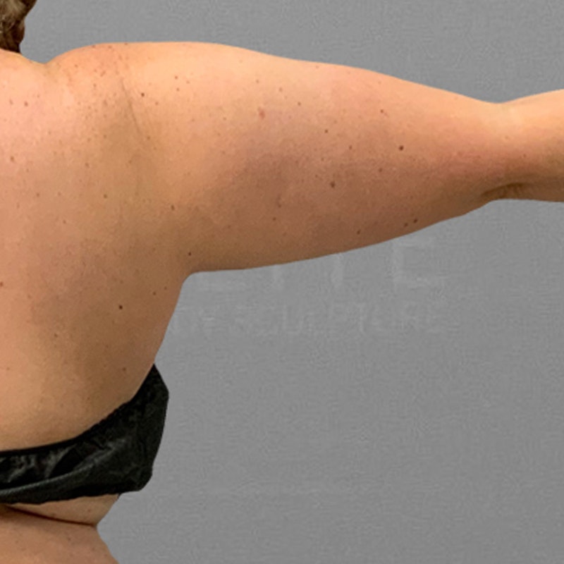 arm airsculpt before