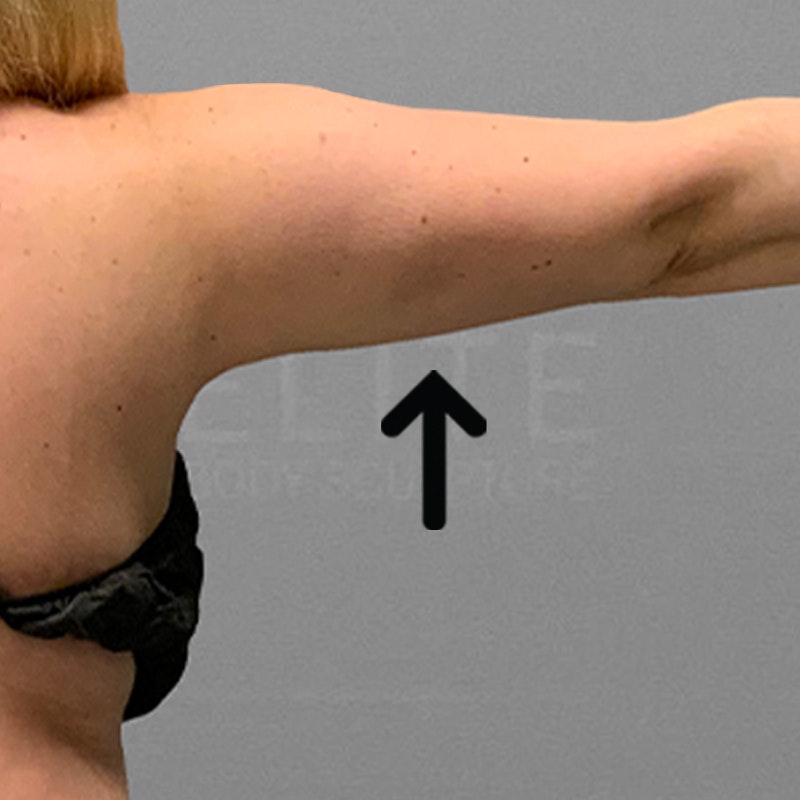 arm airsculpt after