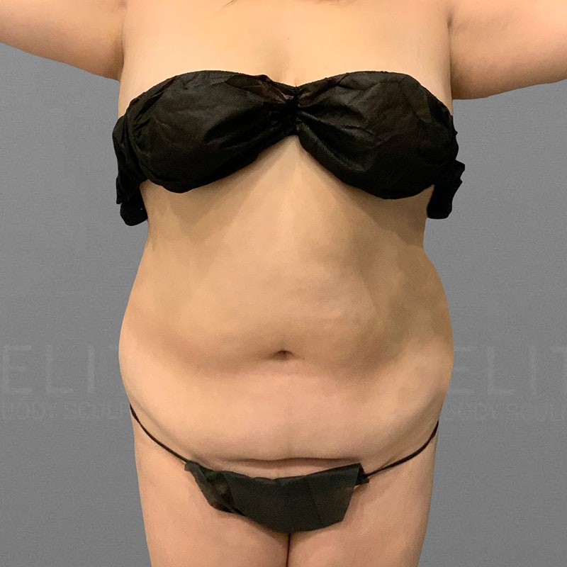 before stomach airsculpt