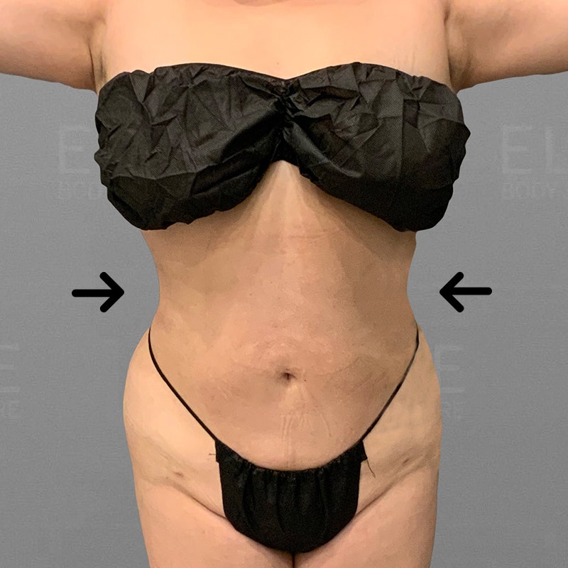 after stomach airsculpt