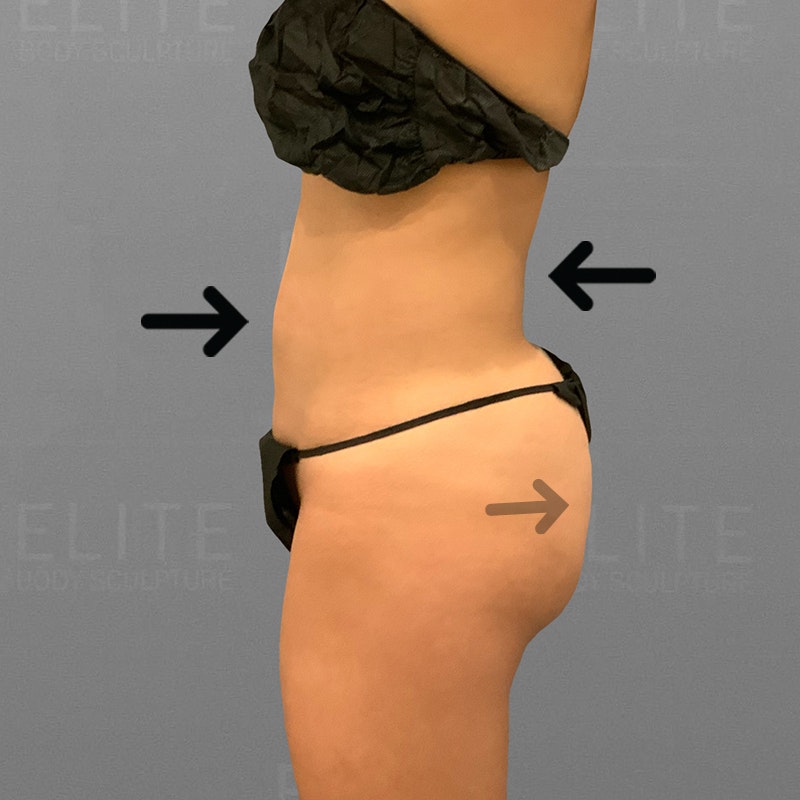 after stomach and BBL AirSculpt