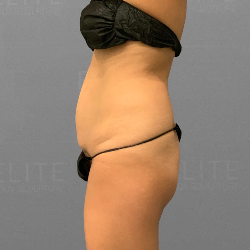 before Stomach and BBL AirSculpt