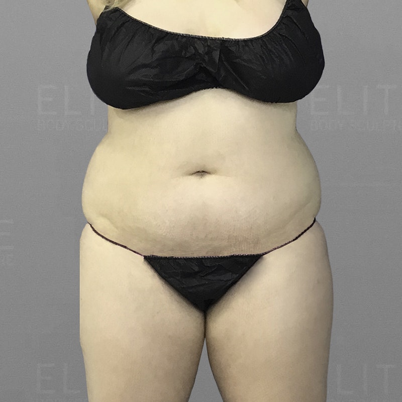 before stomach airsculpt