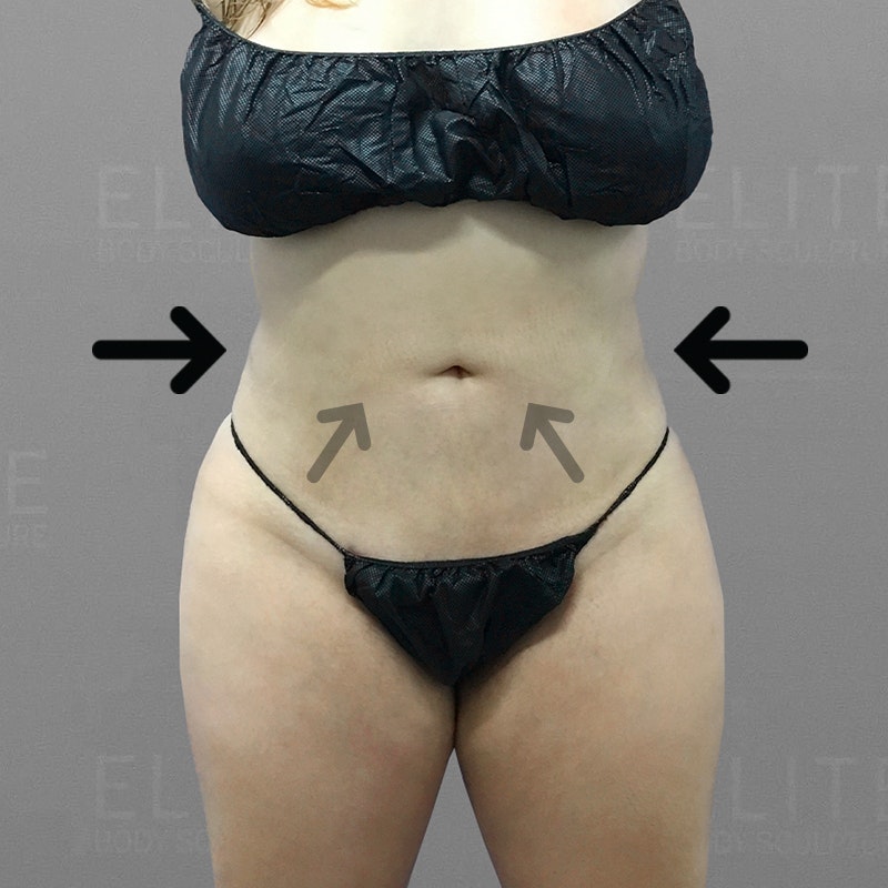 after stomach airsculpt