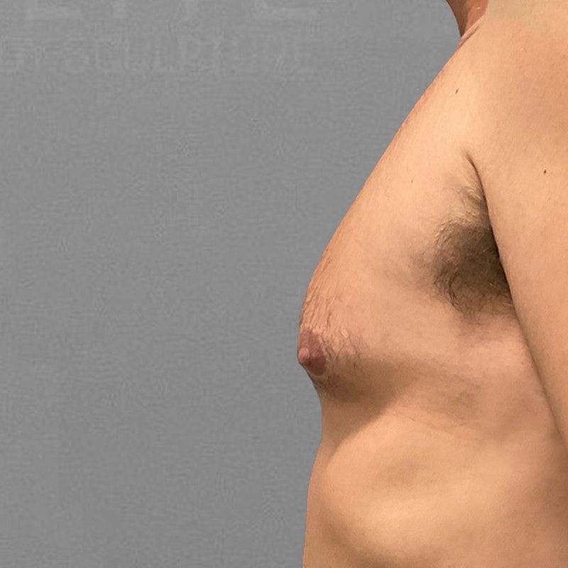 before male chest airsculpt