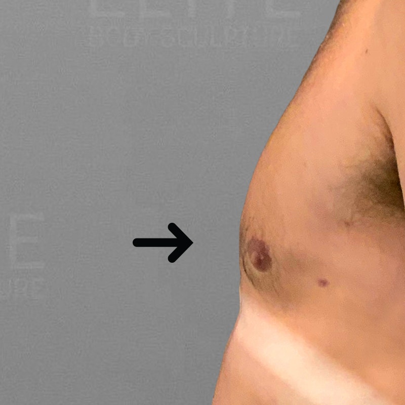 after male chest airsculpt