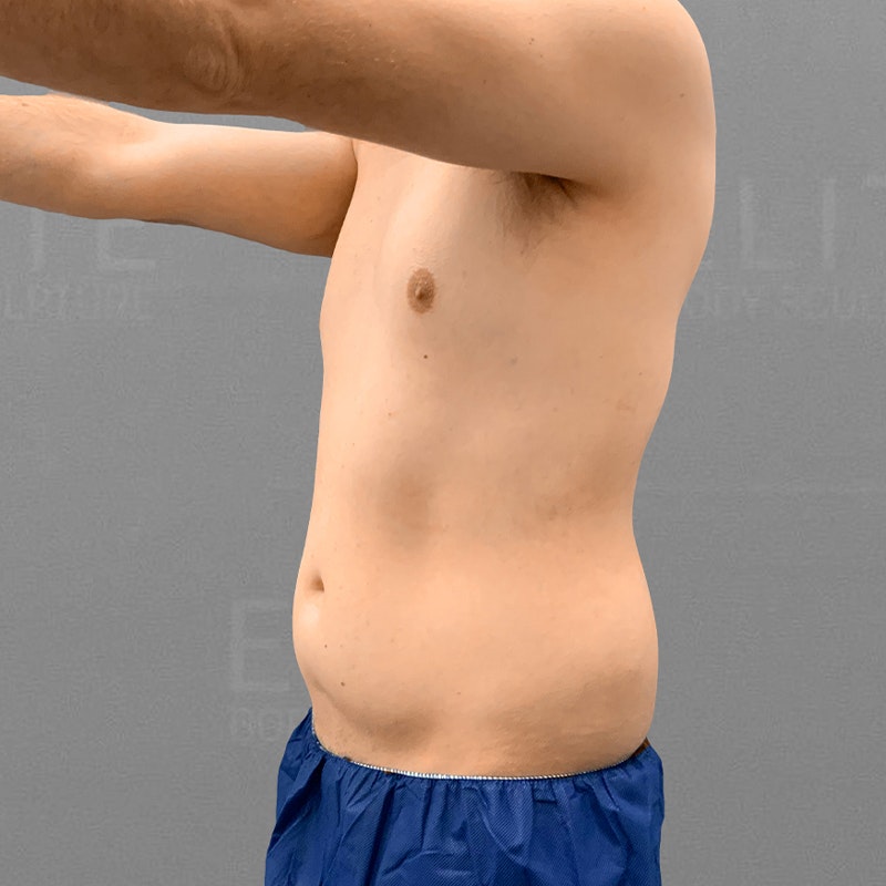 before 48 hour six pack lipo