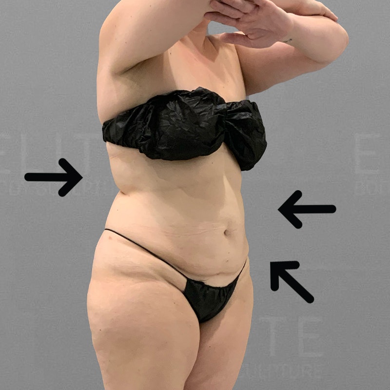 full ab lipo after