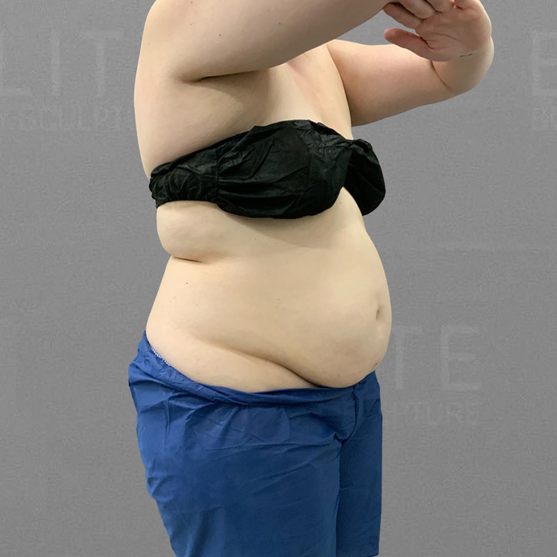 full ab lipo before