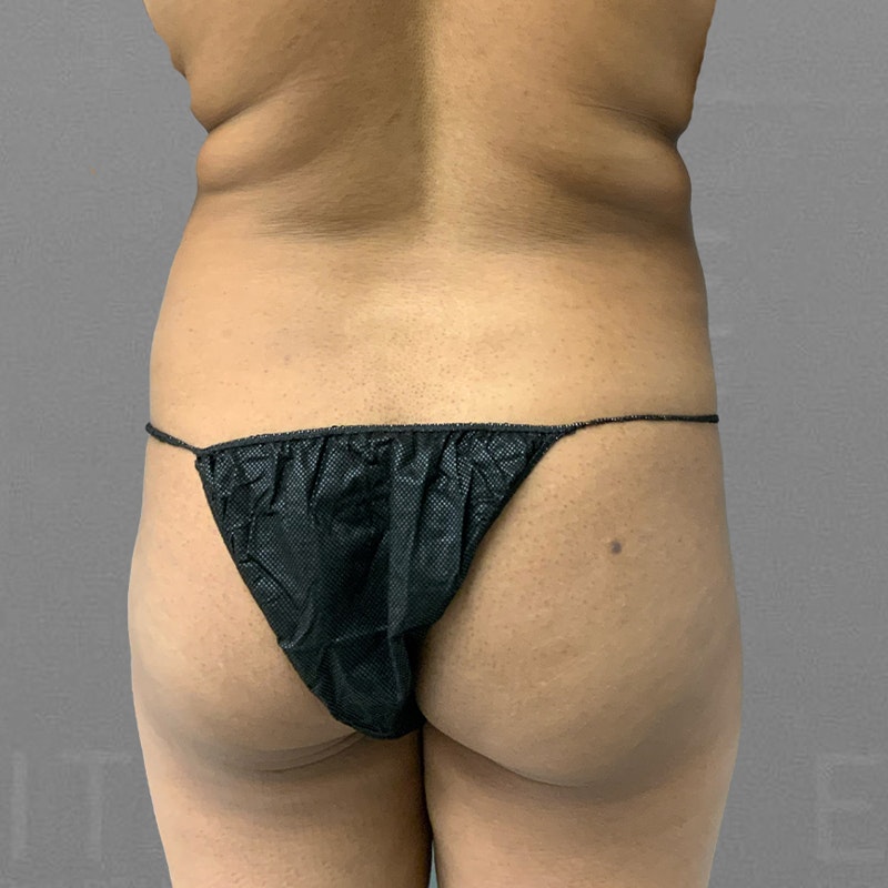 before back and bbl airsculpt