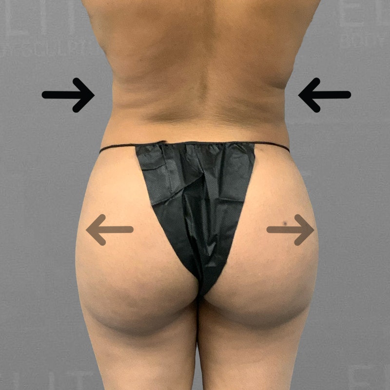 after back and BBL airsculpt 